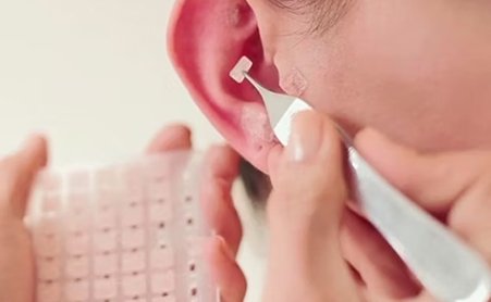 Auriculoterapia